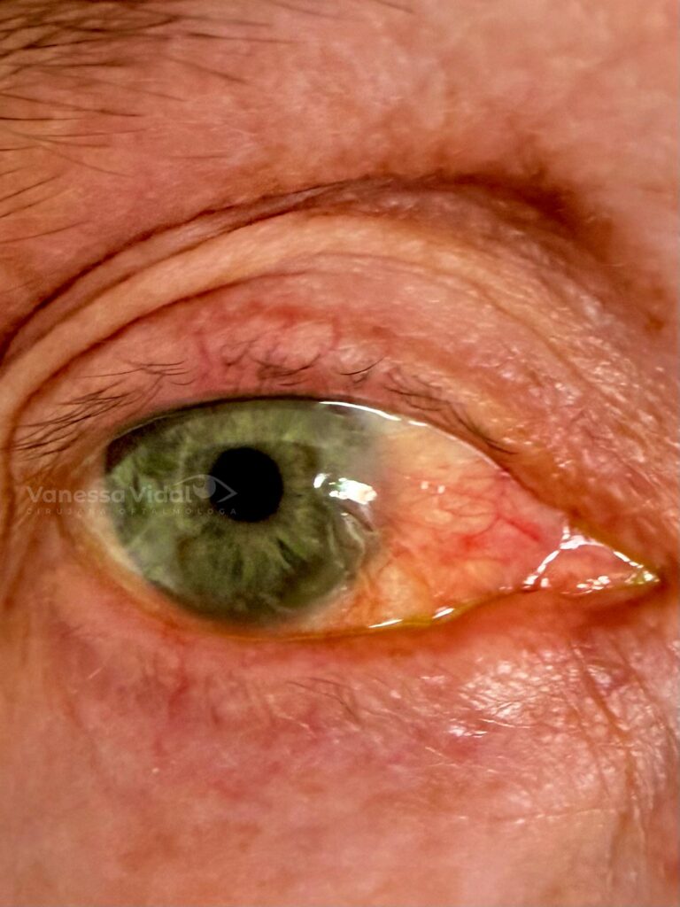 pterigion-o-carnocidad-en-el-ojo