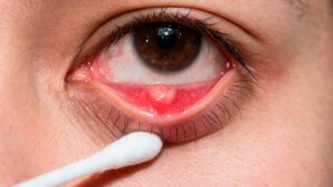 cirugia-de-chalazion-en-bogota-dra-vidal