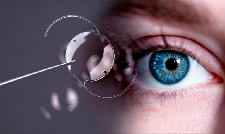 Lentes Intraoculares en Bogotá: La Guía Médica Definitiva de Tecnología Premium para Recuperar tu Visión Sin Gafas